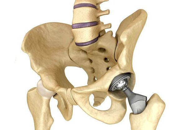 Hip joint endoprosthetic