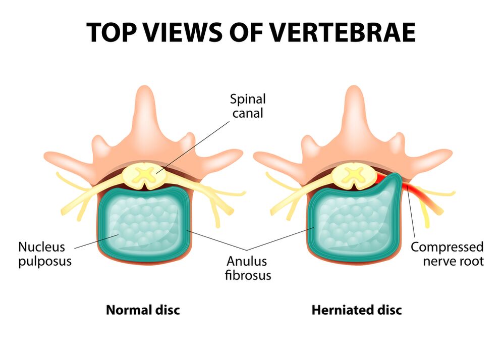 Healthy and hernia intervertebral disc