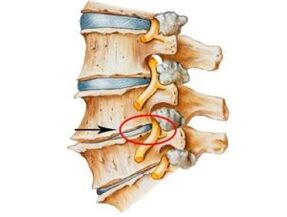 Signs and symptoms of osteochondrosis