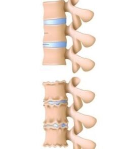 The causes of osteochondrosis