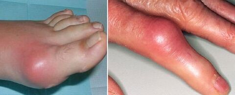 appearance of joints suffering from arthritis