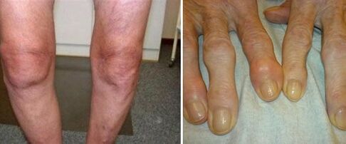 appearance of joints suffering from osteoarthritis