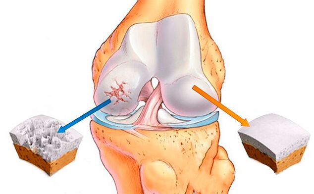 A normal knee joint (right) and osteoarthritis (left)