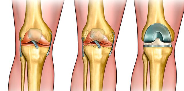 In the third stage of osteoarthritis, knee replacement is necessary