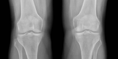 knee osteoarthritis x-ray