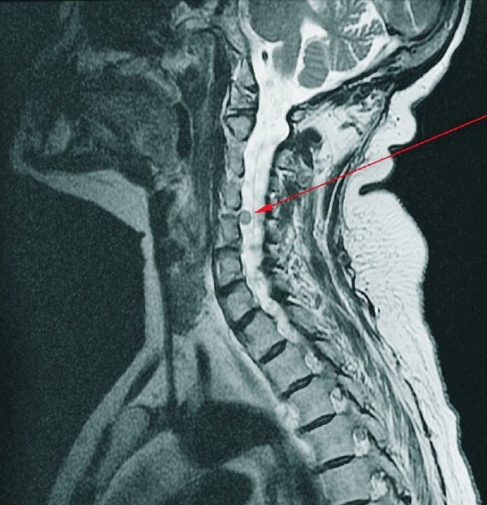 Intervertebral hernia of the cervical spine on MRI