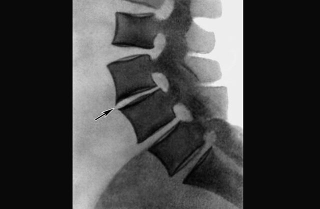 Manifestations of osteochondrosis of the thoracic spine on the x-ray