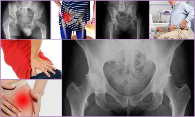 Pain and reduced mobility are the main symptoms of hip osteoarthritis