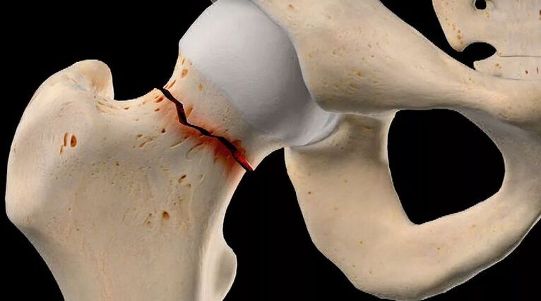 The fracture of the femoral neck is one of the causes of secondary hip osteoarthritis. 