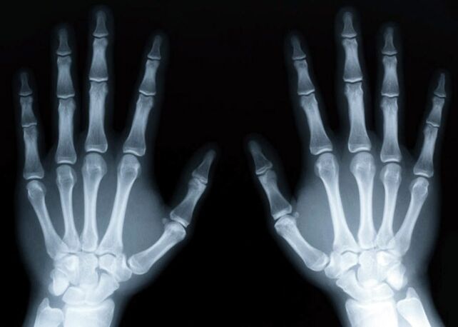 Gout causes the development of gouty arthritis, which can be diagnosed by x-ray